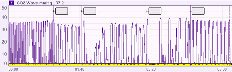 Capnometer showing effort